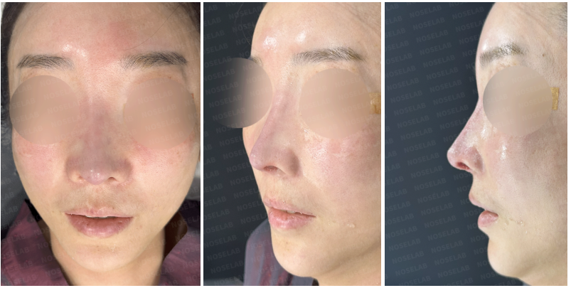 Immediately after complex revision rhinoplasty – frontal, side, and oblique side views of female patient