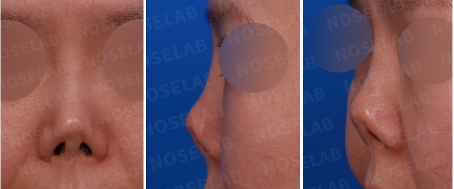 efore contracted nose correction with rib cartilage – frontal, left side, and oblique side views showing severe nostril asymmetry, upturned nasal tip, and collapsed bridge after long-term contraction.