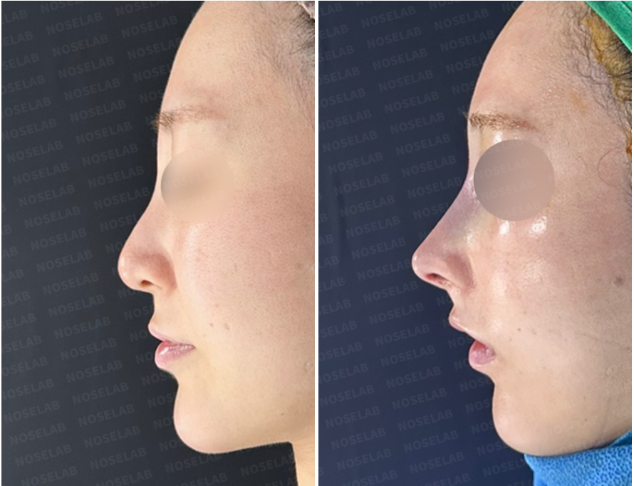 Side profile photos before (left) and immediately after (right) nasal filler removal, dorsal hump refinement, and functional rhinoplasty