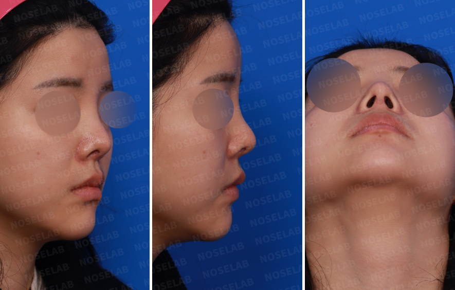 Upturned Nose Correction – Preoperative Right Side, Oblique, and Nostril View Showing Over-Rotated Tip and Wide Nasal Bridge