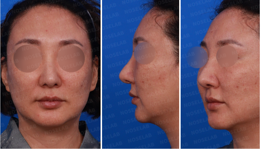 Design consultation photos before revision rhinoplasty after hump removal – frontal, left side, and oblique views showing nasal deviation and bulbous tip.