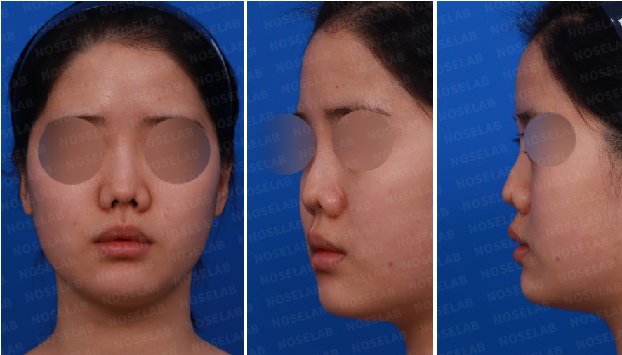 Correcting Nostril Stenosis – Design consultation showing frontal, left side, and oblique side view photos before revision rhinoplasty.