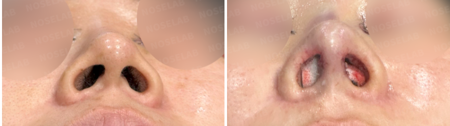 Nasal base view before (left) and immediately after (right) columella depression correction surgery