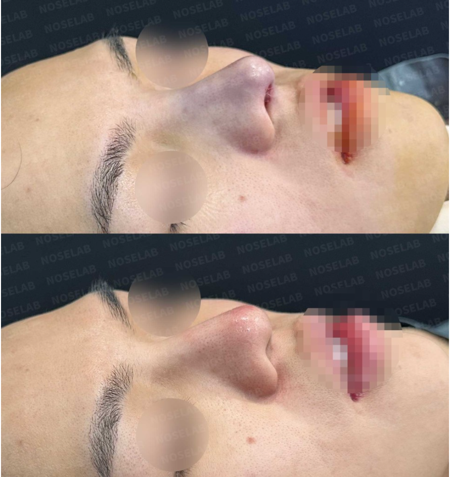 Before and after 45-degree view – correction of droopy nasal tip and deviated bridge using self-rib cartilage closed rhinoplasty (Noselab Clinic)