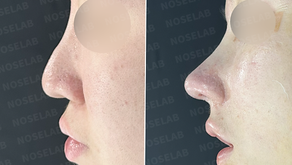 Reconstruction of a collapsed columella and correction of a drooping nasal tip using autologous rib cartilage – before and after side view.