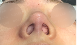 Nostril view immediately after surgery showing cartilage correction and natural nasal tip refinement.