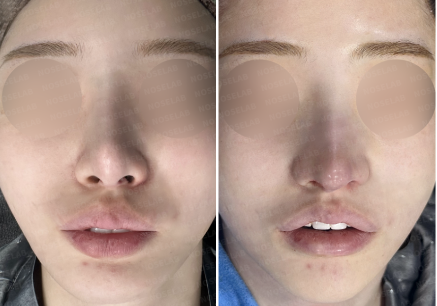 Before and immediately after closed rhinoplasty Korea, frontal view comparison showing improved nasal symmetry, refined nasal tip projection, corrected septal alignment, and a smoother, more balanced nasal contour after structural reconstruction.