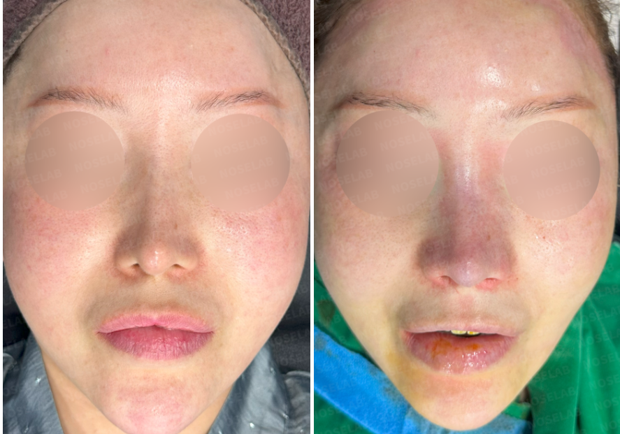 Frontal view before and immediately after contracted nose reconstruction surgery, showing correction of nasal deviation and nostril asymmetry.