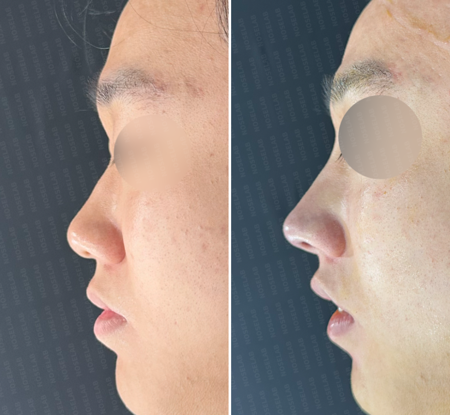 Rhinoplasty Korea – Side view comparison before surgery (left) and immediately after surgery (right), showing enhanced nasal bridge height, corrected nasolabial angle, and improved tip refinement.