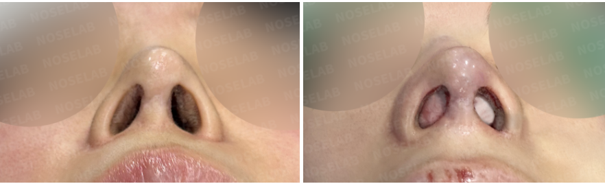 Before and immediately after surgery nostril view showing widened nasal airway and improved nostril symmetry following septal reconstruction and structural revision rhinoplasty with autologous rib cartilage.