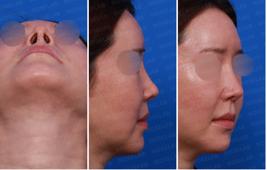 Pre-surgery design consultation photos showing nostril view, right side view, and oblique side view of the patient before revision rhinoplasty