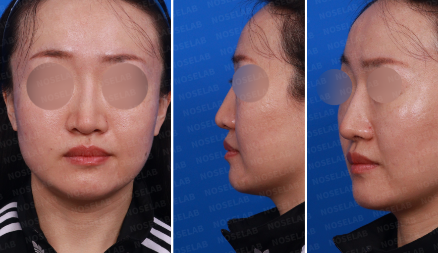Preoperative consultation photos before bulbous tip correction: frontal view, left oblique view, and left profile showing nasal length and asymmetry.