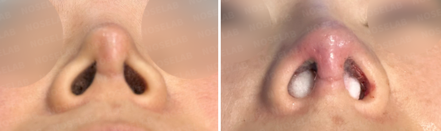 Nasal base view before (left) and immediately after (right) contracted nose correction surgery