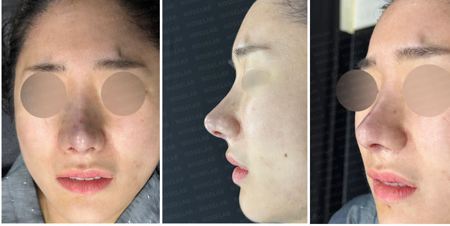 Immediately after surgery photos of nostril reconstruction following excessive nostril reduction – frontal view, side profile, and 45-degree oblique angle with rib cartilage graft and closed rhinoplasty
