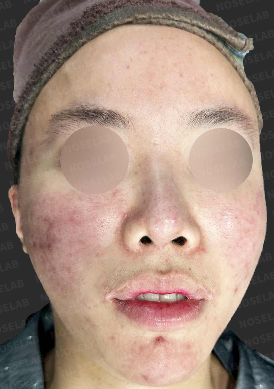 Before surgery: frontal view.