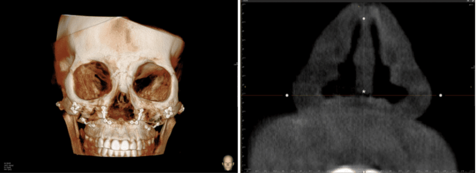 Preoperative 3D skull image and CT scan showing nasal structure before blunt nose correction and septum reconstruction planning.