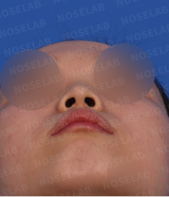 Short nose rhinoplasty – pre-surgery design consultation nostril view photo