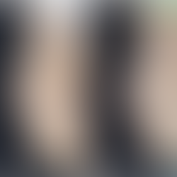 High Radix Rhinoplasty Korea before and after correcting upturned nasal tip and symmetry