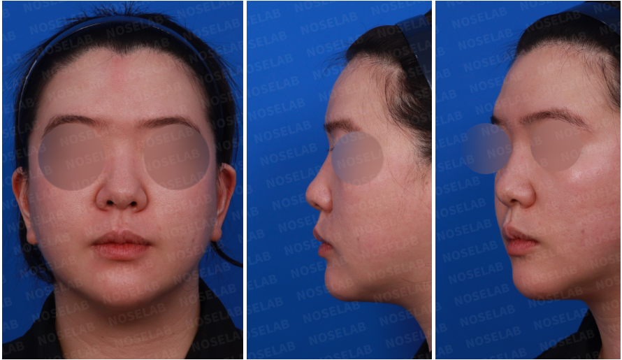 Design consultation photos showing frontal, left side, and oblique side views of a patient prior to bulbous nose correction and closed rhinoplasty at Nose Lab Clinic.