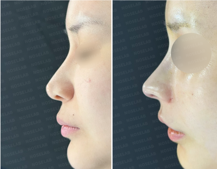 Post-Orthognathic Septal Reconstruction side view – before and immediately after closed rhinoplasty revision showing improved nasal bridge alignment and refined tip projection.