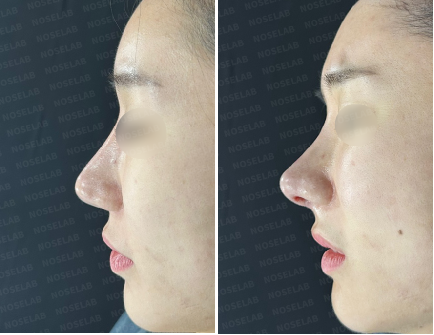 Before and immediately after revision rhinoplasty for correcting overly reduced alar base – right side view