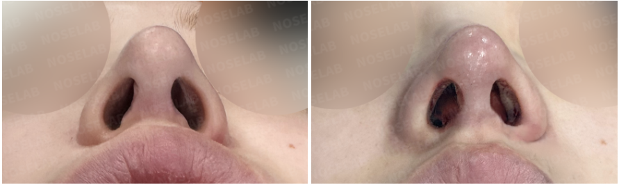 Before and immediately after closed rhinoplasty Korea, nostril base view comparison showing reduced nostril exposure, improved symmetry, stabilized columella position, and balanced nasal base after structural tip reconstruction.