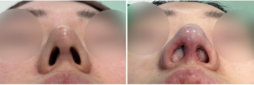 Before surgery (left), After surgery (right)