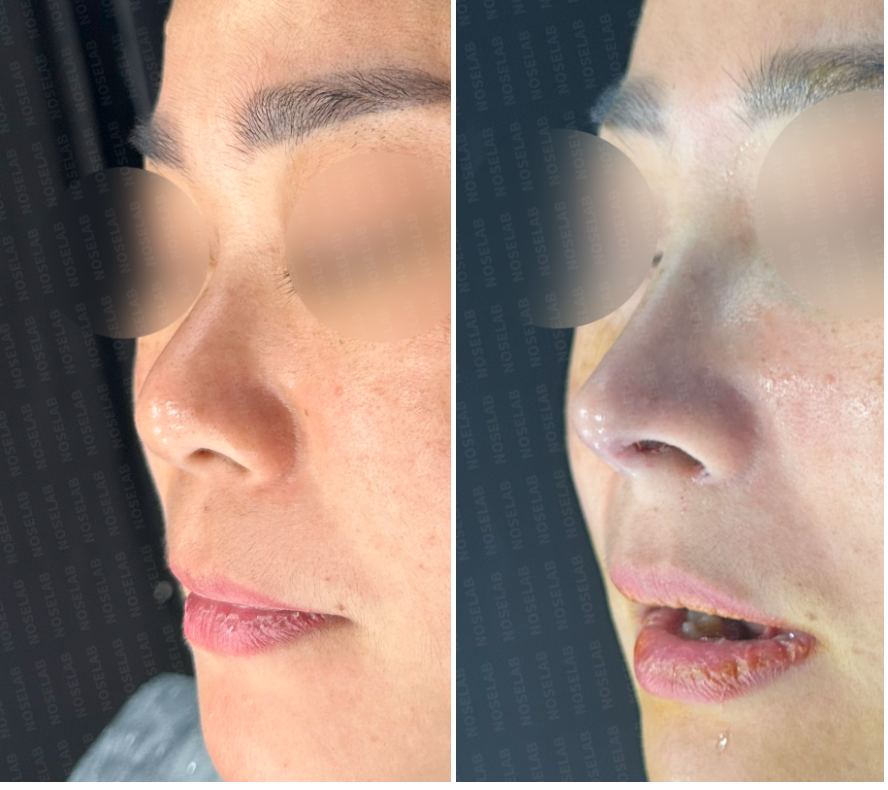 Short Nose Correction – Oblique Side View Before (Left) and Immediately After Surgery (Right)