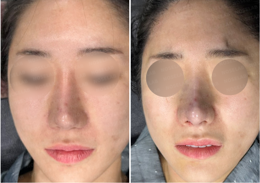 Before and immediately after frontal view of nostril reconstruction following excessive nostril reduction with rib cartilage graft and closed rhinoplasty