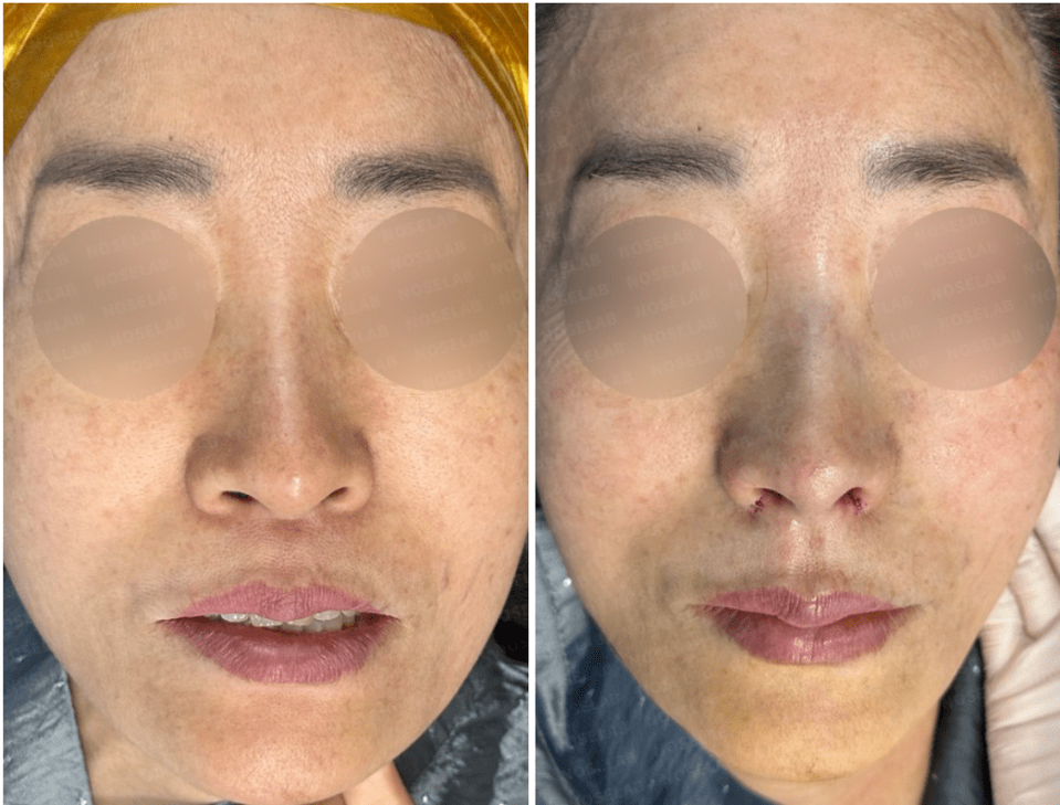Before surgery (left), after surgery (right)