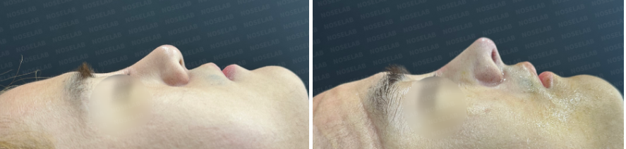 before and after side profile view of silicone exposure rhinoplasty showing lowered radix, improved nasal tip projection, and stabilized nasal structure after closed rhinoplasty Korea