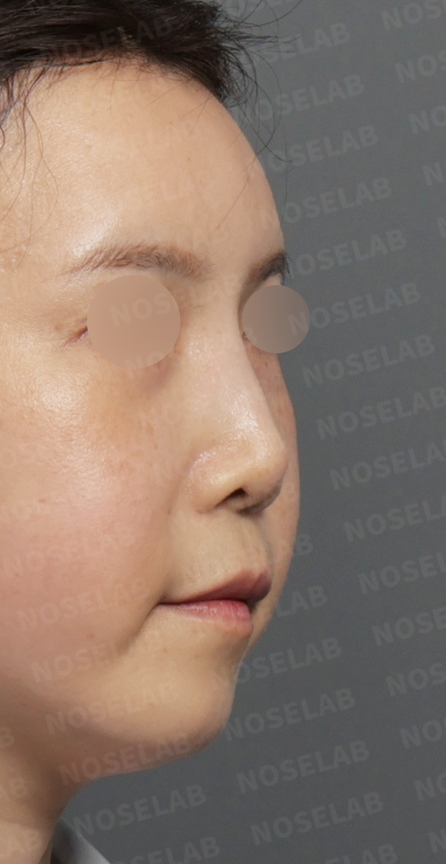 Preoperative consultation: right oblique view.