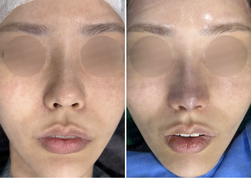 Frontal view before and immediately after autologous rib cartilage rhinoplasty