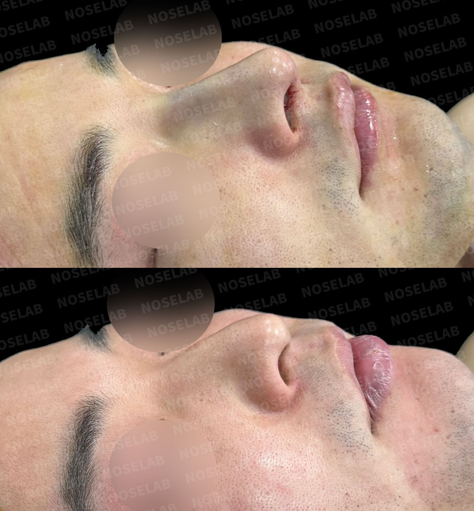 “Before and after 45-degree angle photos of deviated nose correction and hump removal through closed rhinoplasty. The natural slope and nasal bridge line are smoothly connected for a refined appearance. (Noselab Clinic)”