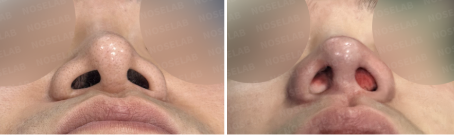Nostril view comparison showing preoperative nasal airway narrowing on the left and immediate postoperative appearance on the right after septal reconstruction and bilateral alar cartilage reconstruction.