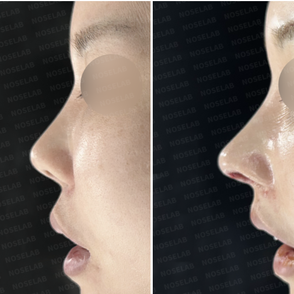 Side before and immediately after views showing improved nasal length and lower tip position after rib cartilage reconstruction.
