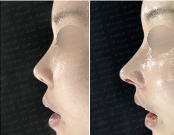 Side before and immediately after views showing improved nasal length and lower tip position after rib cartilage reconstruction.