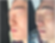 Before and after scar tissue nasal reconstruction with rib cartilage – oblique 45-degree view of male patient