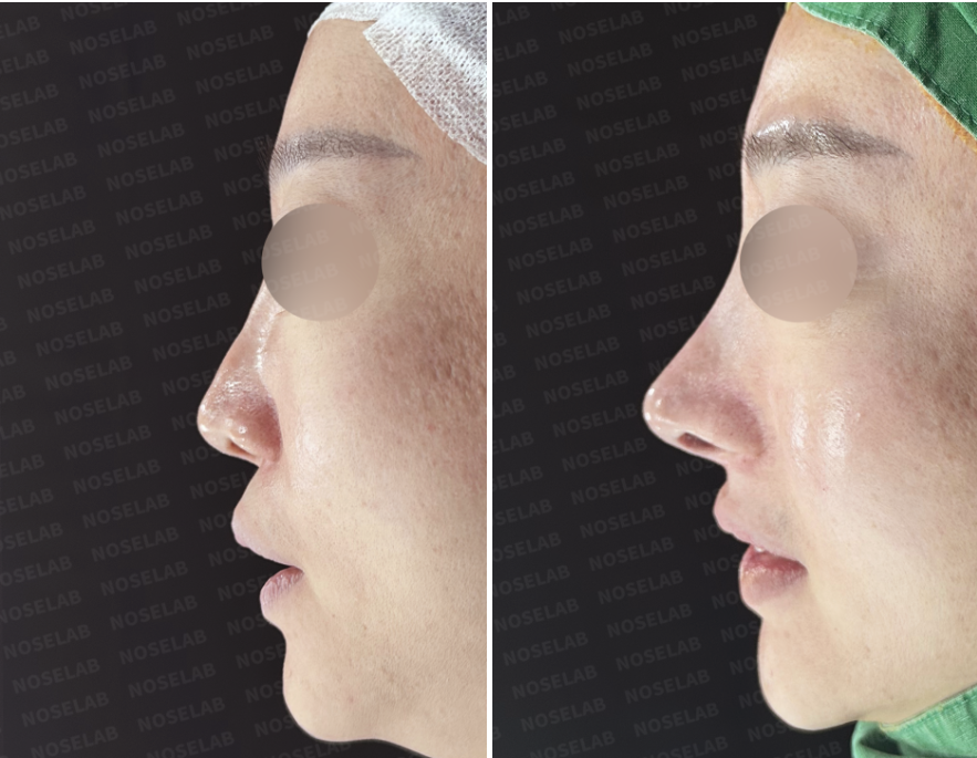 Side profile before and immediately after autologous rib cartilage revision rhinoplasty