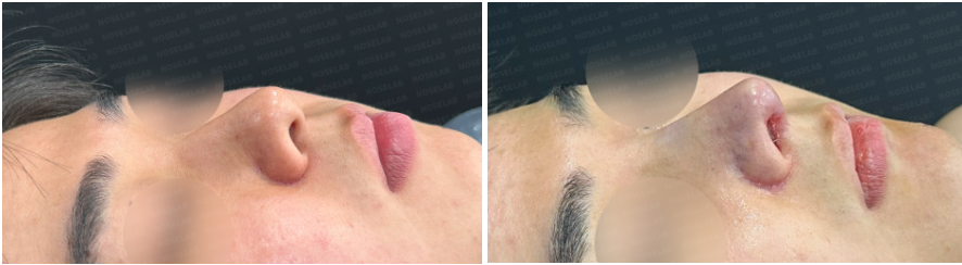 Before and immediately after Short and Low Nasal Bridge Rhinoplasty: oblique side view showing smoother nasal contour, tip refinement, and improved harmony with facial features.