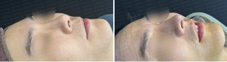 Oblique side view before and after male rhinoplasty Korea: improved nasal symmetry and masculine contour