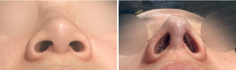 Nostril view before and after rhinoplasty – improved nostril symmetry and nasal base alignment.
