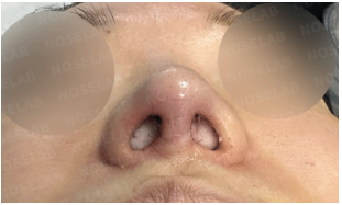 Immediately after revision rhinoplasty correcting nostril asymmetry caused by synthetic dermal graft absorption – close-up nostril view.