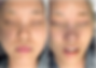 Before and immediately after small blunt nose correction surgery – frontal comparison photos