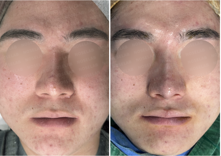 Before and immediately after frontal view following closed rhinoplasty Korea for high nose correction, showing improved nasal bridge height and symmetry using a 3D custom implant and autologous rib cartilage.