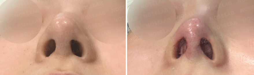Correction of Drooping Nasal Tip and Nostril Asymmetry – Base view before and immediately after closed rhinoplasty at Nose Lab Clinic