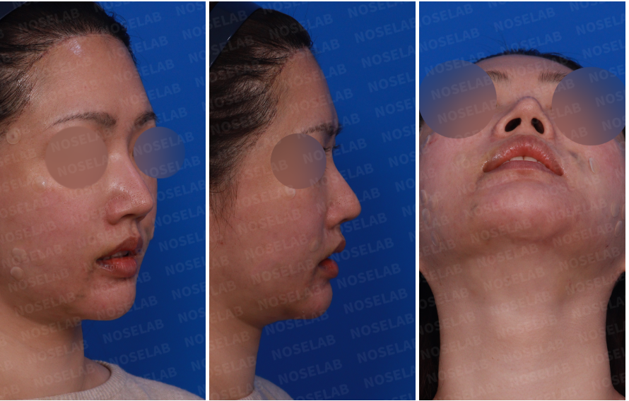 Design consultation photos showing a female patient’s nose from the right side, oblique side, and nostril view before rhinoplasty.