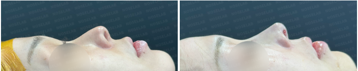 Before surgery (left), after surgery (right)