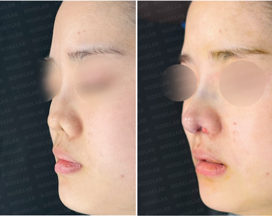 Correcting Nostril Stenosis – Before (left) and immediately after (right) revision rhinoplasty, close-up side view photos