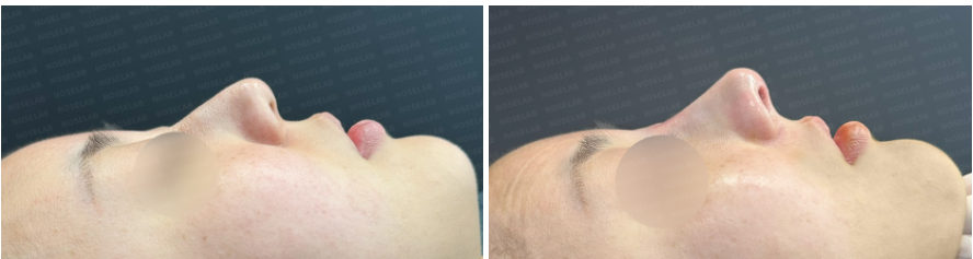 Side profile view before surgery (left) after surgery (right)